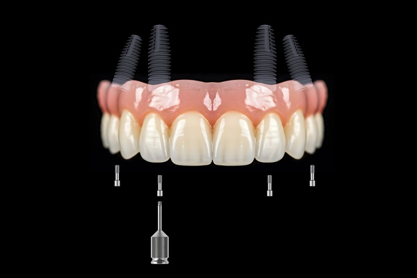 How The Placement Angle Affects All On   Implants